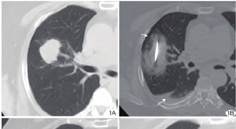 Cryoablation Lung Cancer Treatment