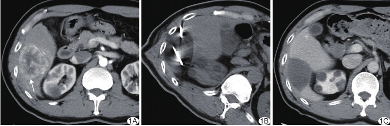 Cryoablation For Liver Cancer