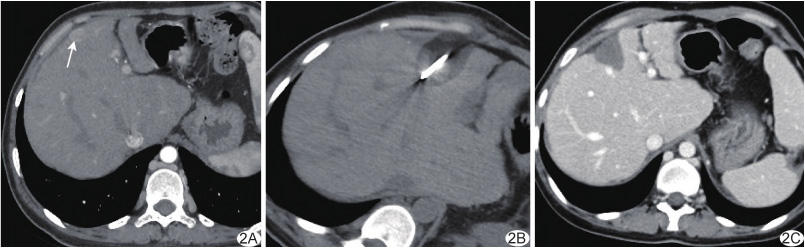 Liver Cancer Cryoablation