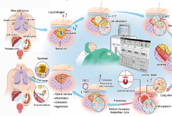 Expert Consensus on Clinical Practice of Multi-Model Ablation for Treatment of Liver Malignant Tumors