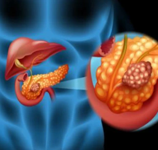 CRYOABLATION FOR PANCREATIC CANCER