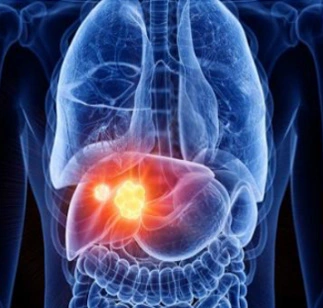 CRYOABLATION FOR LIVER CANCER