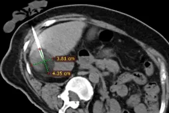 Expert Consensus on Clinical Practice of Multi-model Cold and Hot Ablation for Treatment of Liver Malignant Tumors