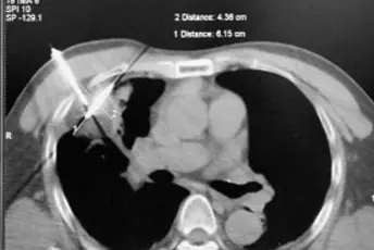 ​Expert Consensus on Clinical Practice of Percutaneous Cold and Hot Multi-modal Ablation for Treatment of Pulmonary Malignant Tumor