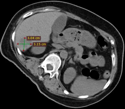 cryotherapy liver