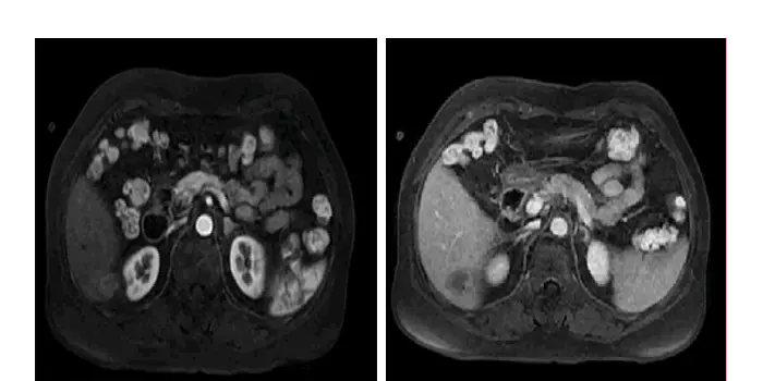 Reexamination 1 month after surgery