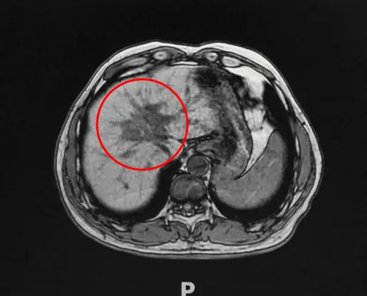 liver cancer cryoablation