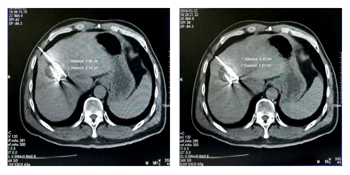 Ablation-two cycles