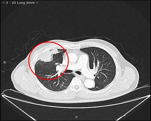 cryotherapy lung metastases