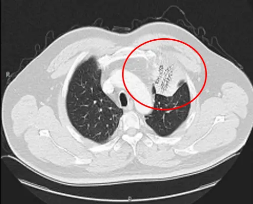 cryosurgery for lung cancer