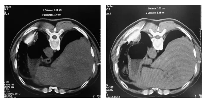 Ablation-two cycles