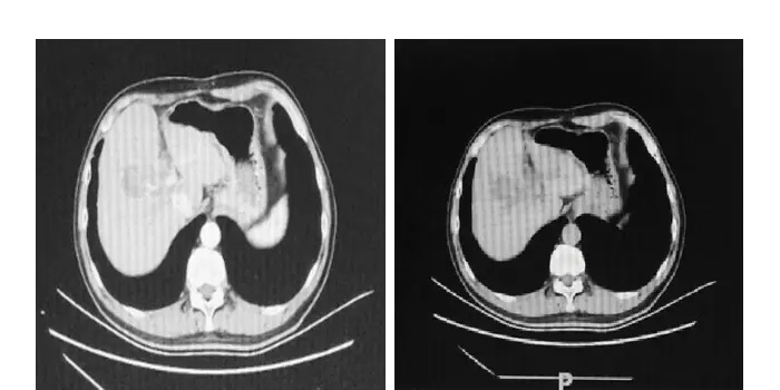 Reexamination 1 month after surgery