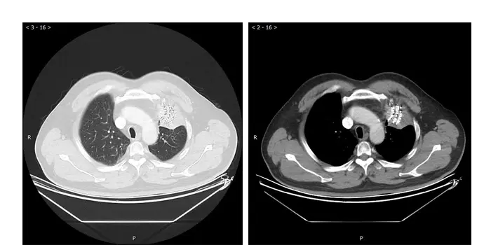 The reexamination 6 months after surgery showed complete remission (CR)