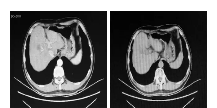 Reexamination 3 months after surgery, CT showed complete remission (CR)