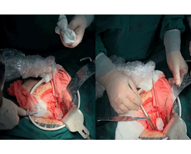cryoablation surgery for pancreas