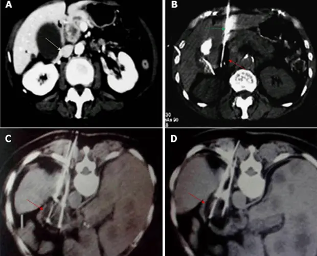 cryoablation therapy for pancreas