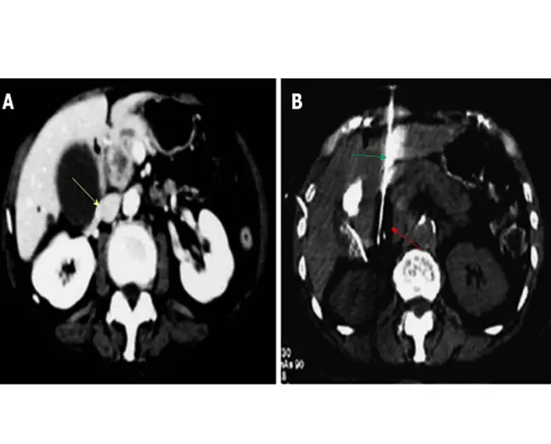 cryoablation treatment for pancreas